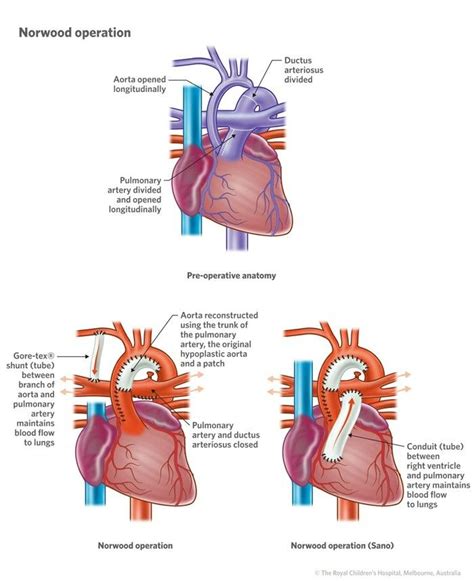 rv to pa conduit procedure.